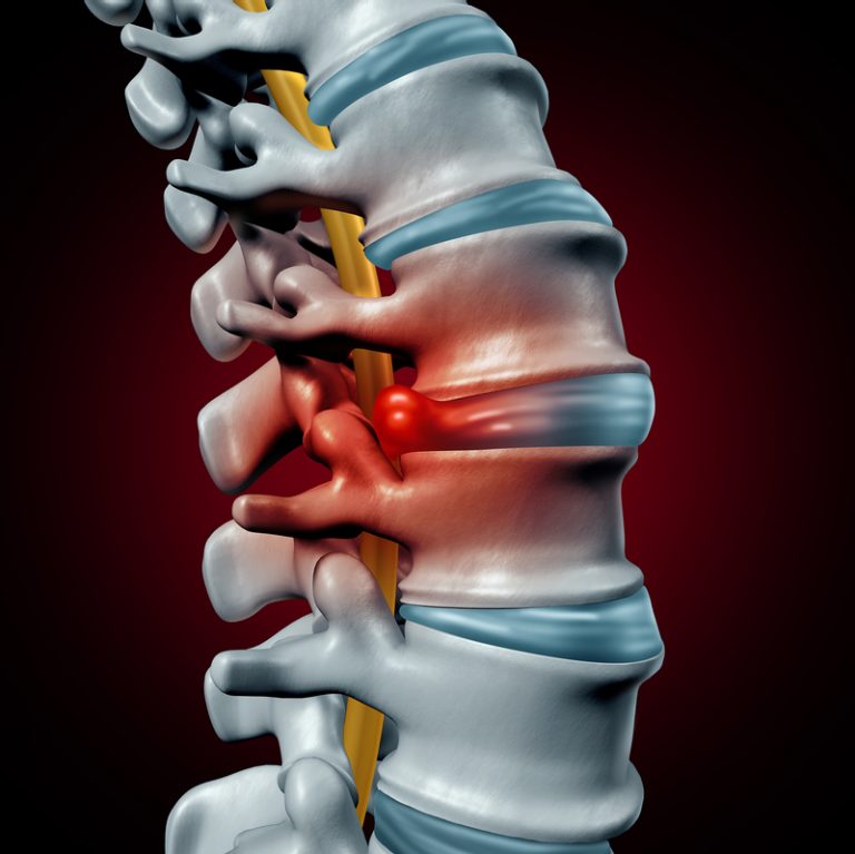 Illustration showing a human spine with a herniated disc and highlighted pain area