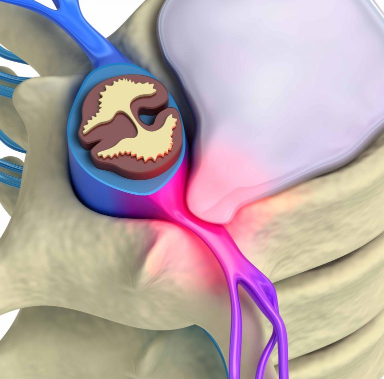 Anatomical illustration of a spinal disc bulge, highlighting the affected area.