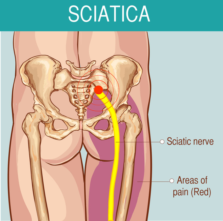 Illustration of the sciatic nerve pathway from the lower back to the leg.